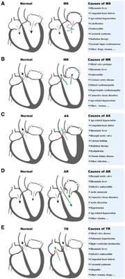 Different heart failure phenotypes of valvular heart disease: the role of mitochondrial dysfunction